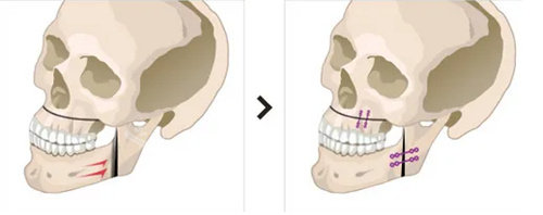 雙顎整形手術示意圖