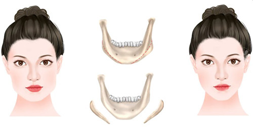 下颌角手术前后对比