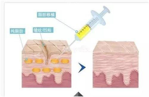 韩国贝缇莱茵整形医院脂肪示意图