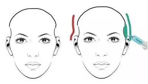 韩国贝缇莱茵整形太阳穴凹陷示意图