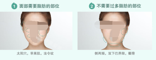 韓國貝緹萊茵整形醫(yī)院脂肪填充部位示意圖