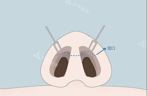 鼻整形切口示意图