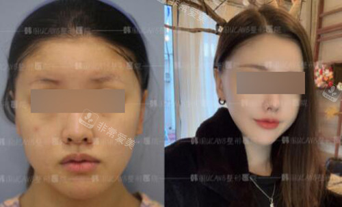 韓國UcanB整形外科面部不對稱改善 韓國UcanB整形外科面部不對稱改善