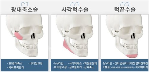韩国绮林整形外科李承龙院长面部轮廓整形项目