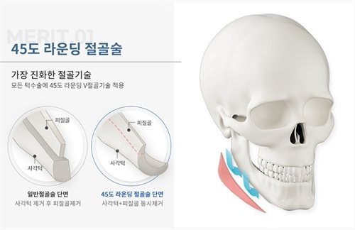 韩国绮林整形外科李承龙院长下颌角45度旋转截骨示意图