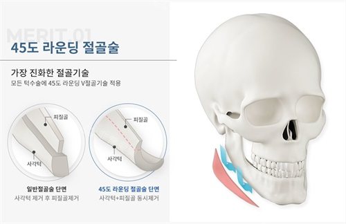 韓國綺林整形外科李承龍?jiān)洪L(zhǎng)下頜角45度旋轉(zhuǎn)截骨示意圖
