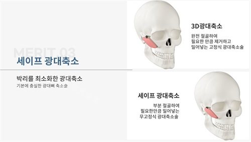 韓國綺林整形外科李承龍院長顴骨整形示意圖 韓國綺林整形外科李承龍院長顴骨整形示意圖