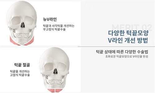 韩国绮林整形外科李承龙院长下颌角下巴手术示意图