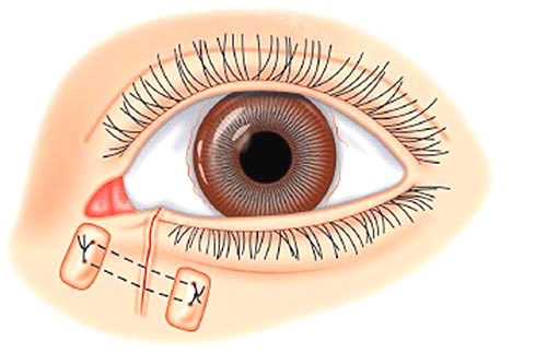 韩国芙莱思整形医院眼睛手术图