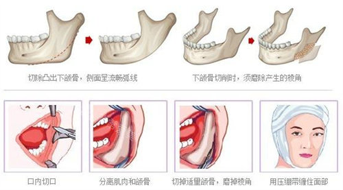 下頜角磨骨示意圖