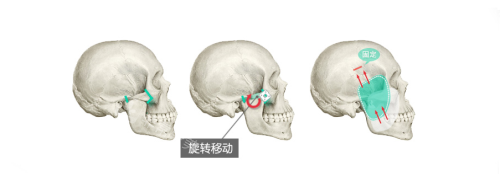 韓國(guó)貝緹萊茵整形醫(yī)院顴骨手術(shù)過(guò)程示意圖