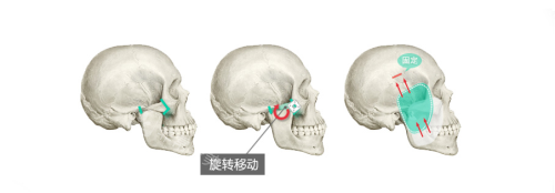 韩国贝缇莱茵整形医院颧骨手术过程示意图