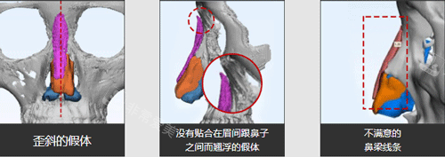 隆鼻术前设计方案图