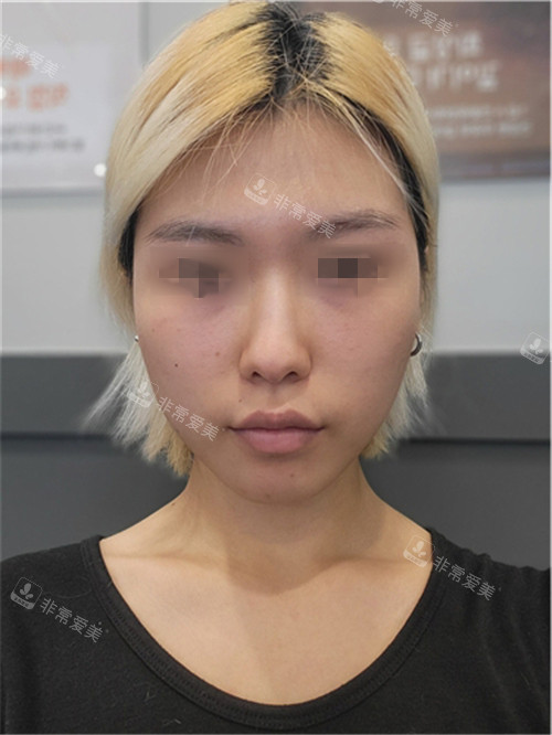韩国优雅人整形鼻部+面部脂肪填充术前图