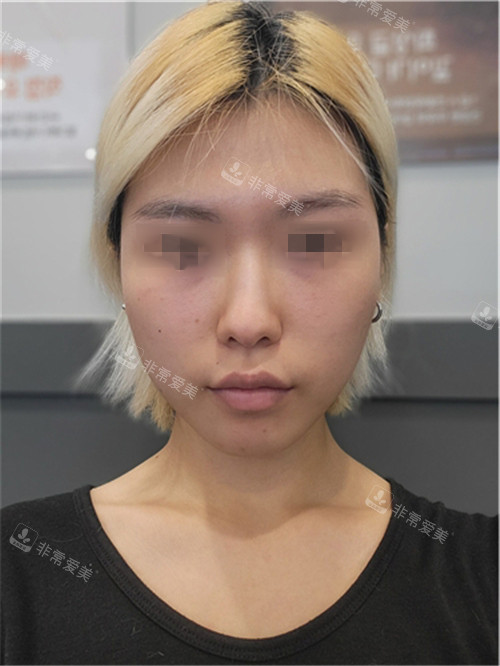 韓國優(yōu)雅人整形鼻部+面部脂肪填充術前圖 韓國優(yōu)雅人整形鼻部+面部脂肪填充術前圖