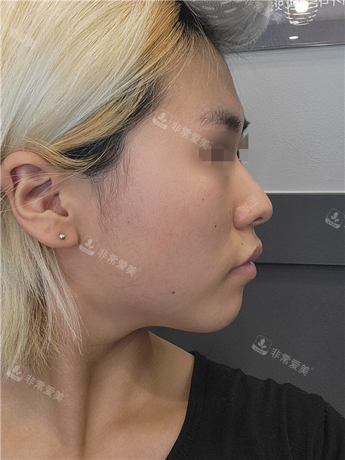 韩国优雅人整形鼻部+面部脂肪填充术前侧面