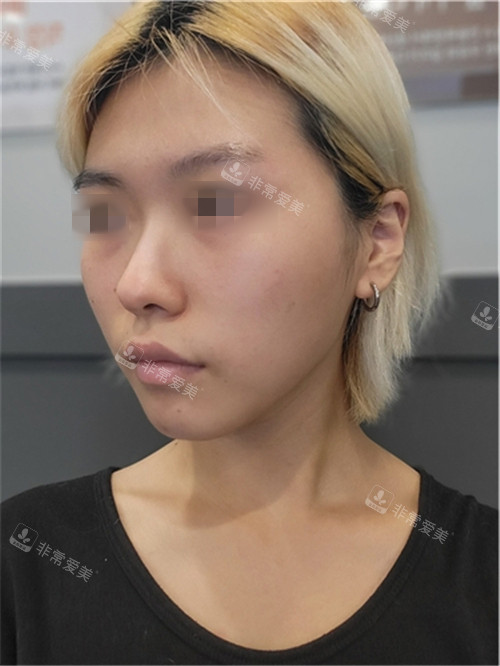 韩国优雅人整形鼻部+面部脂肪填充术前图术前图片展示