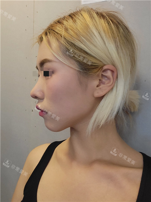 韩国优雅人整形鼻部+面部脂肪填充术后侧颜