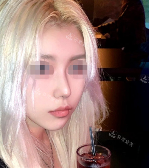 韩国优雅人整形鼻部+面部脂肪填充术后变化展示图