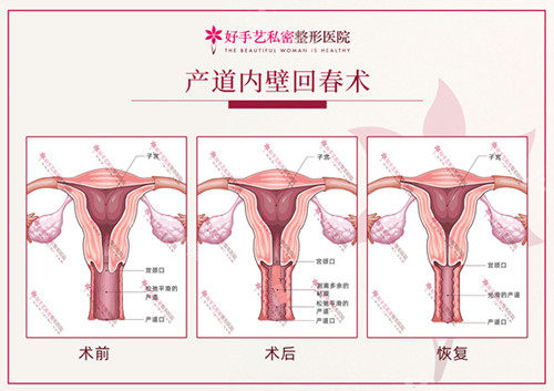 韓國好手藝婦科縮陰手術(shù)