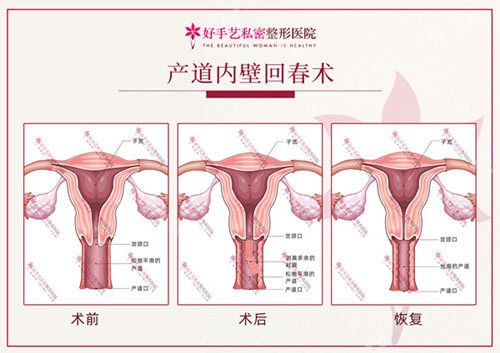 韓國(guó)好手藝婦科縮陰手術(shù)