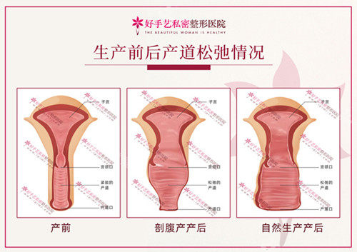 女性生產(chǎn)前后產(chǎn)道松弛情況