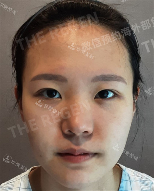韩国德丽珍整容外科眼鼻整形术前图