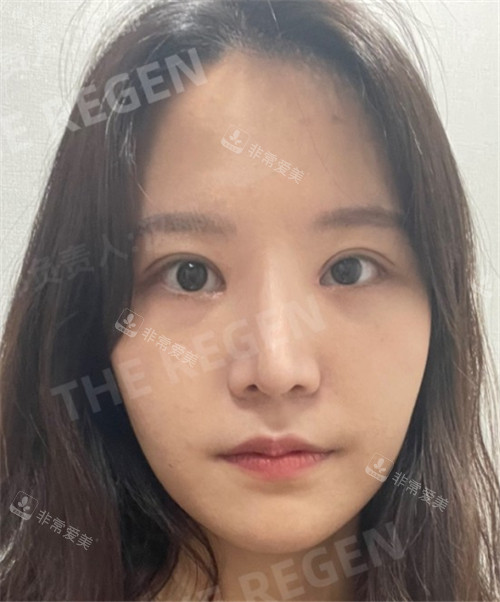 韩国德丽珍整容外科眼鼻整形术后图
