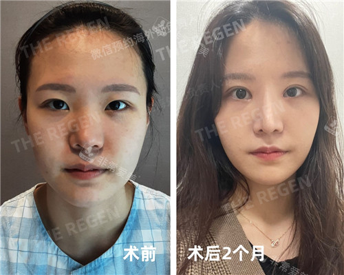 韩国德丽珍整容外科眼鼻整形前后对比