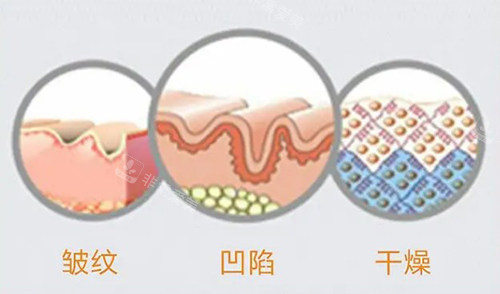 玻尿酸可改善的范圍