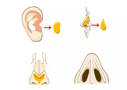 自体软骨隆鼻