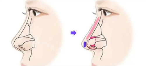 隆鼻前后对比图