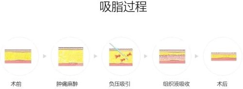 吸脂過程示意圖