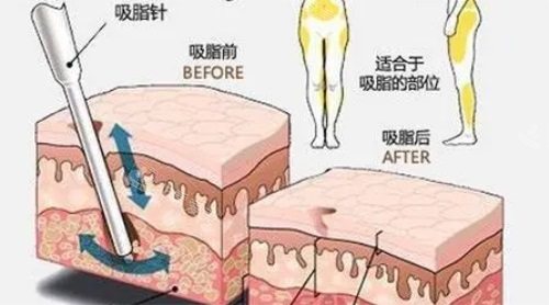 吸脂前后對(duì)比圖 吸脂前后對(duì)比圖