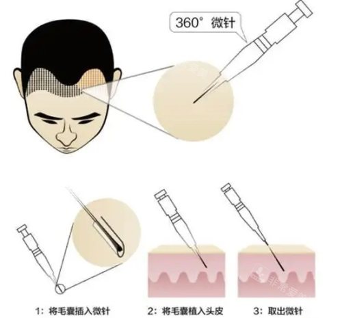 提取毛囊过程示意图