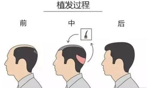 植發(fā)過程前中后示意圖 植發(fā)過程前中后示意圖