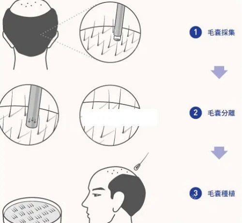 毛囊種植過程圖 毛囊種植過程圖