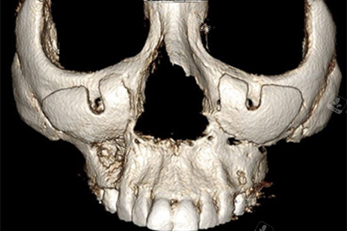 韩国H整形外科医院前颧骨假体植入手术图解1