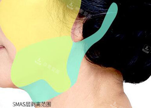 韓國(guó)秀美顏整形面部除皺剝離示意圖 韓國(guó)秀美顏整形面部除皺剝離示意圖