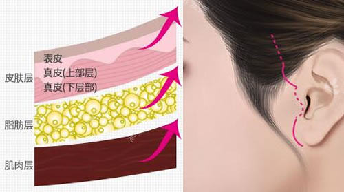 韩国秀美颜整形外科除皱细节展示