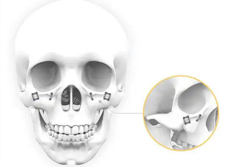 前颧骨假体植入怎么做的？韩国H整形外科医院图解很清晰！