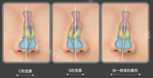 韩国贝缇莱茵整形医院歪鼻矫正手术方法