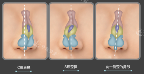 鼻整形就选韩国贝缇莱茵整形医院,歪鼻/鹰钩鼻/短鼻都超赞