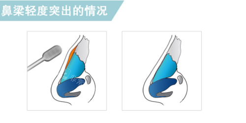 韩国贝缇莱茵整形医院轻度鹰钩鼻手术方法