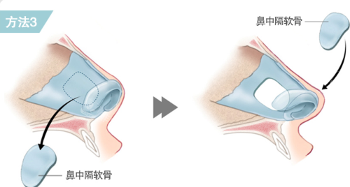 韩国贝缇莱茵整形医院短鼻鼻中隔手术