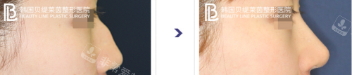 韩国贝缇莱茵整形医院鹰钩鼻手术实例