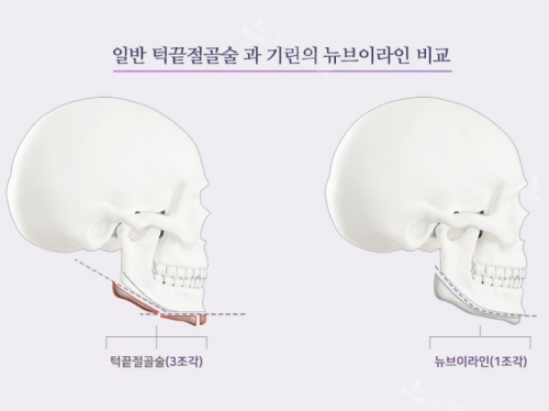 韓國綺林整形外科下頜角手術(shù)示意圖