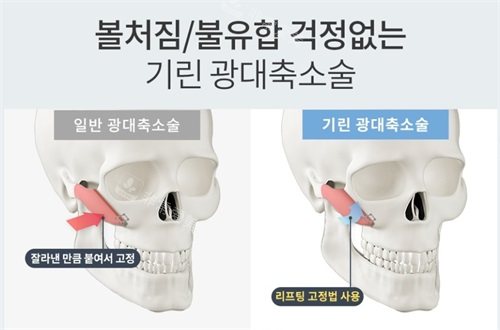 韩国绮林整形外科颧骨手术对比传统颧骨手术