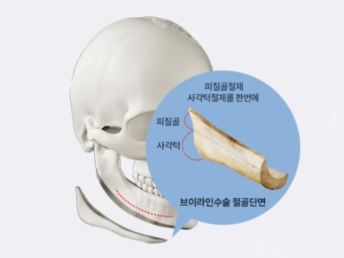 韩国绮林整形外科下颌角切除示意图