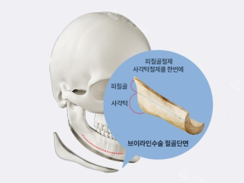韓國綺林整形外科下頜角切除示意圖